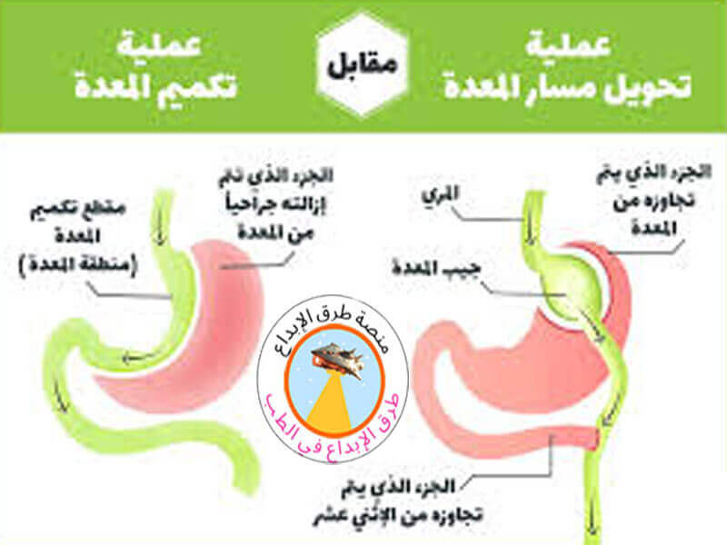 الفرق بين التكميم وتحويل مسار المعدة 1