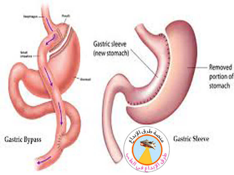 الفرق بين التكميم وتحويل مسار المعدة 2