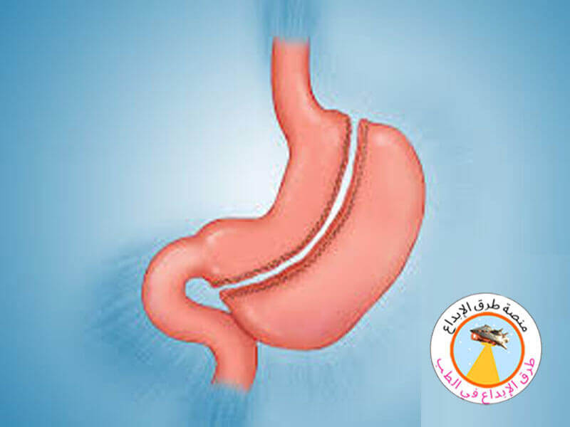 الفرق بين التكميم وتحويل مسار المعدة