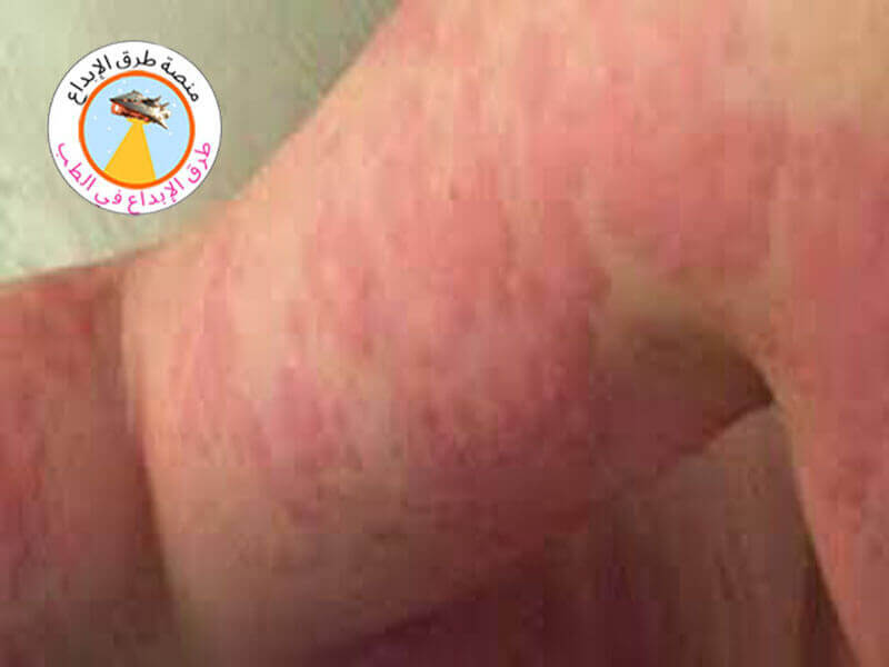 علاج حساسية الطعام في المنزل 1