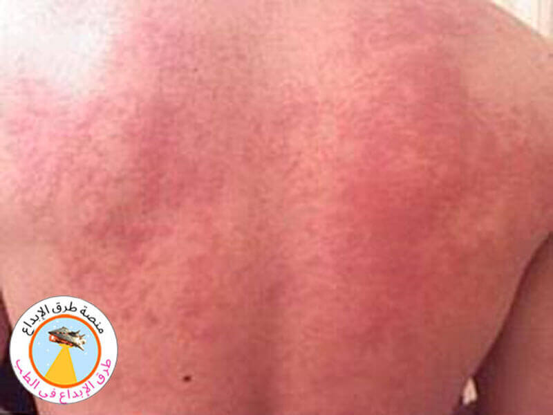 علاج حساسية الطعام في المنزل