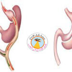 الفرق بين التكميم وتحويل مسار المعدة 3