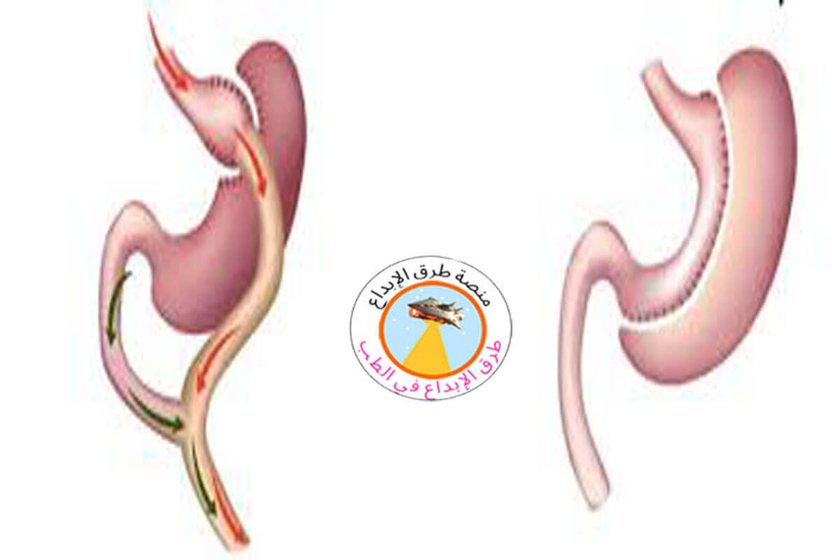 الفرق بين التكميم وتحويل مسار المعدة 3