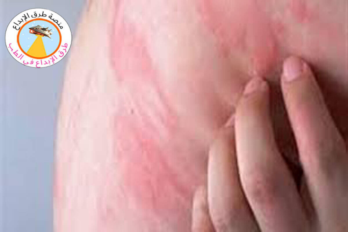 علاج حساسية الطعام في المنزل 2